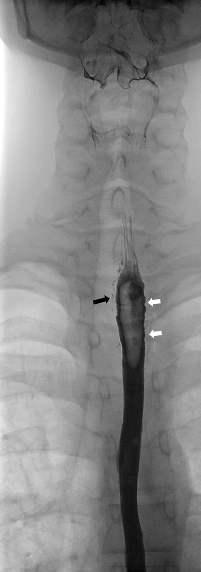 A 15-year-old boy was referred for a barium swallow investigation as part of a workup for chronic dysphagia and odynophagia. His symptoms commenced after the endoscopic removal of an impacted tablet several years earlier. (c) An AP projection of the esophagus, from the same study, shows traces of contrast in the false lumen (black arrow) and evidence of dysmotility, characterized by nonperistaltic contractions at the site of dissection.