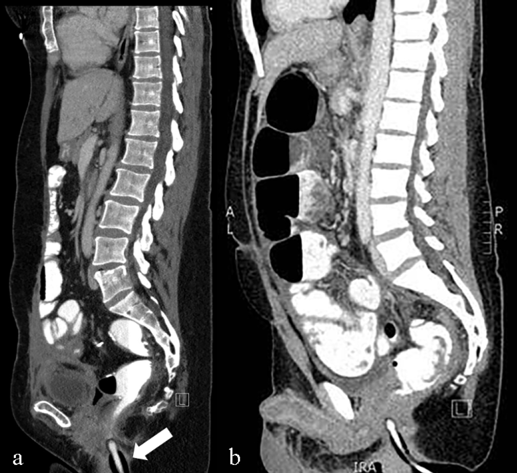 (a) Sagittal reconstruction of a rectal enema CT using the dual balloon catheter however the distal balloon has been inflated BELOW the anorectal junction (arrow). Note the quality of the colonic distention remains diagnostic. (b) Sagittal reconstruction of a rectal enema CT using the dual balloon catheter, however the distal balloon has not been inflated. The conical shaped proximal balloon has been inflated with the degree of colonic distention remaining diagnostic.