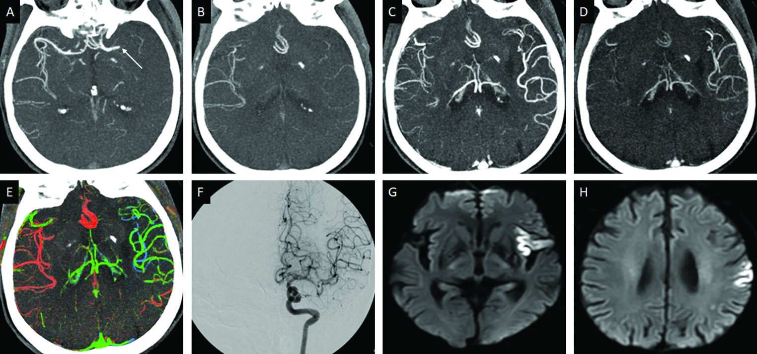 Grade 2 (intermediate) collaterals in an 81-year-old male patient presenting with acute right hemiplegia and slurring of speech. Axial arterial phase MIP-CTA (A), demonstrates thrombo-occlusion (arrow) of the left M1-MCA. Axial MIP images distal to the occlusion in the arterial (B), venous (C), and post-venous (D), phases demonstrate a 1-phase delay in the appearance of the collateral vessels. Axial ColorViz map (E) reveals predominantly green, and few blue, collaterals. rTPA was administered, leading to recanalization of the left MCA (F), 24-hour DWI follow-up reveals acute infarcts scattered in the left MCA territory (G, H).