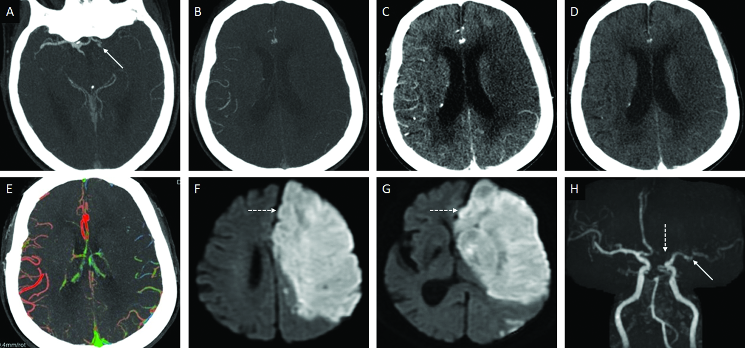 Grade 1 (poor) collaterals in an 83-year-old female patient presenting with acute left hemispheric syndrome. Axial arterial phase MIP-CTA (A), demonstrates thrombo-occlusion (arrow) of the proximal left M1-MCA. Axial MIP images distal to the occlusion in the arterial (B), venous (C), and post-venous (D), phases demonstrate near complete absence of pial collaterals. Axial ColorViz map (E) confirms sparse collaterals in the left MCA territory. rTPA and MT were not performed in view of the large infarct core with no penumbra on the CTP (not shown). 24-hour DWI follow-up (F, G) confirms an extensive acute infarct involving the left MCA territory. A new acute infarct was also detected in the left ACA territory (dotted arrows). Time-of-Flight MR Angiogram (H) shows interval partial recanalization of the left MCA (arrow) with a new occlusion of the left ACA (dotted arrow).