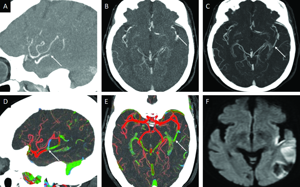 Left M2-MCA occlusion (MeVO) in an 80-year-old female patient presenting with a fall subsequent to acute right hemiplegia. Sagittal (A) and axial (B) arterial phase MIP-CTA images demonstrate thrombo-occlusion of the inferior division of the left MCA (arrow). Axial MIP images obtained in the venous (C) phase demonstrate preserved opacification beyond the occlusion (arrow) in keeping with the “delayed vessel sign.” Sagittal (D) and axial (E) ColorViz maps show an abrupt change in color (arrow) along the occluded left M2-MCA from red to green-blue. 24-hour DWI follow-up (F) confirms an acute infarct involving the posterior left insular cortex and left M3 region.