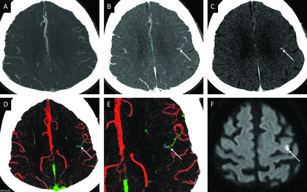 Distal M4 occlusion in a 77-year-old male patient presenting with the right pure motor syndrome. No LVO or MeVO was detected. Axial MIP-CTA images obtained in the arterial (A), venous (B), and postvenous (C) phases show delayed opacification (arrow in B) and washout (arrow in C) in one of the peri-Rolandic M4-MCA branches. Axial ColorViz maps (D, E) demonstrate corresponding blue-green color (arrow). The color-indicator effect of ColorViz helped in identifying the hemodynamic alteration and rTPA was administered. 24-hour DWI follow-up (F) confirms an acute infarct (arrow) in the left precentral gyrus, corresponding to the site of presumed occlusion.