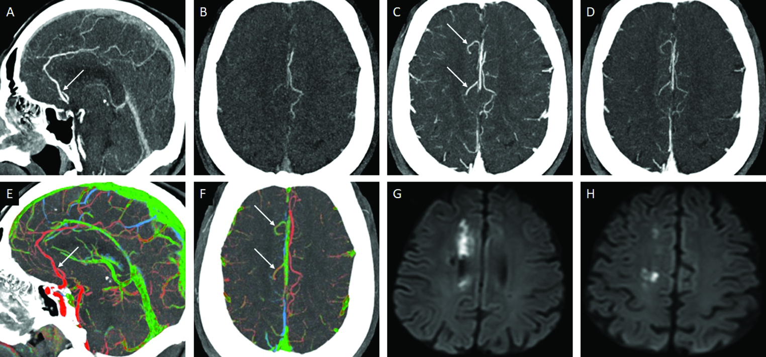 Occlusion of the A2-ACA in a 67-year-old patient presenting with acute left lower limb numbness and weakness. Sagittal arterial phase MIP-CTA image (A) shows thrombo-occlusion of the right A2-ACA segment (arrow). Axial MIP images obtained distal to the site of occlusion in the arterial (B), venous (C) and postvenous (D) phases show delayed distal filling within the cortical branches of the right ACA (arrows in C, D). Sagittal (E) and axial (F) ColorViz maps confirm the site of occlusion (arrow in E) and enable the easy identification of the delayed distal filling (arrow in F). The patient promptly received rTPA. 24-hour DWI follow-up (G, H) confirms multiple acute infarcts scattered in the right ACA territory.
