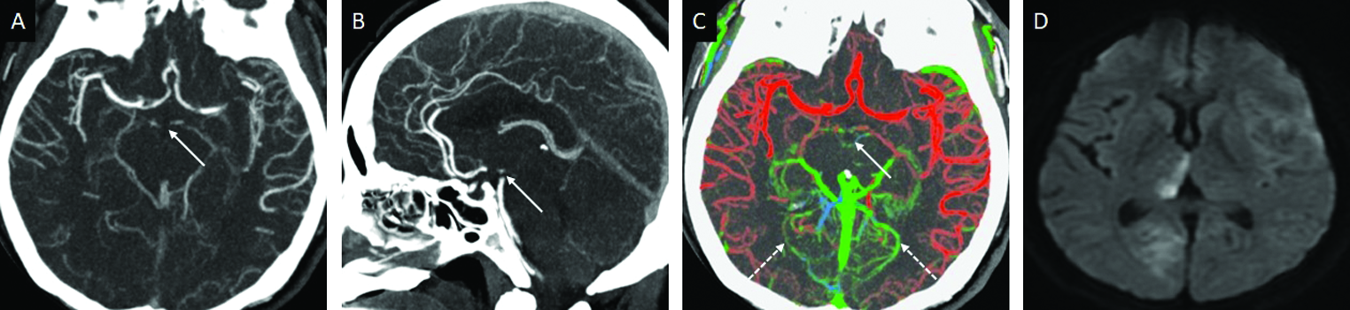 Top of basilar occlusion in a 49-year-old patient with acute loss of consciousness. Axial (A) and sagittal (B) arterial phase MIP-CTA image demonstrate the basilar occlusion (arrows). Axial (C) ColorViz maps confirm the occlusion (arrow) and absent red-colored arteries distally in the PCA territories (dotted arrows). The patient underwent EVT. 24-hour DWI follow up (D) reveals acute infarcts involving the right PCA territory.