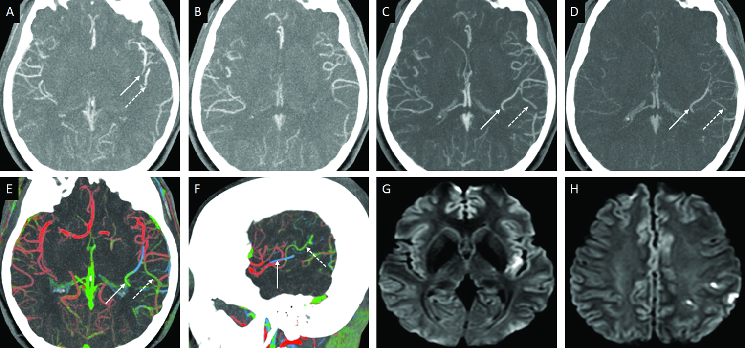 Downstream MVO in a 37-year-old male patient presenting with acute right facial droop. Axial arterial phase MIP-CTA image (A) demonstrates thrombo-occlusion of superior (arrow) and inferior (dotted arrow) divisions of the left MCA. Axial MIP images obtained in the arterial (B), venous (C), and postvenous (D) phases, depict a “delayed vessel sign” distal to the sites of occlusion (C,D). Axial (E) and sagittal (F) ColorViz maps help in easy identification of the MVO characterized by an abrupt change in color from red to green-blue. 24-hour DWI follow-up (G,H) reveals an incomplete left MCA territory infarct involving the posterior insular cortex (G) and the left parietal cortices (H).