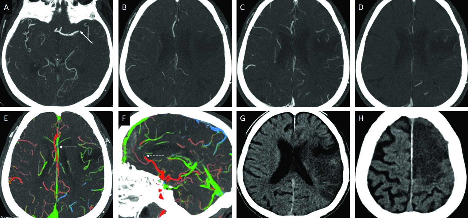 Multiterritorial MVO in a 74-year-old patient presenting with left hemispheric syndrome. Axial arterial phase MIP-CTA image (A) demonstrates thrombo-occlusion of the left M1-MCA (arrow). Axial MIP images obtained distal to the site of occlusion in the arterial (B), venous (C) and postvenous (D) phases demonstrate a 1-phase delay in the appearance of the collateral vessels. Axial ColorViz map (E) shows intermediate left MCA pial collaterals, with predominant green collaterals, however, of note there is impaired filling in the left ACA territory (dotted arrow). Sagittal ColorViz map (F) confirms occlusion of the pericallosal branch of the left ACA (dotted arrow). The color indicator effect of ColorViz helped identify both the occlusions, which was retrospectively confirmed on the mCTA. Follow up CT (G,H) confirms an acute infarct involving the left MCA and ACA territories.