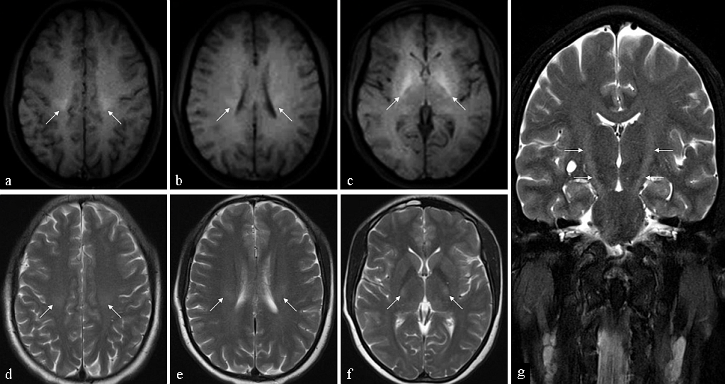 MRI of the 38-year-old male patient who presented with slowly progressive weakness of the upper and lower extremities. Axial T1 (a–c) and axial T2 (d–f) images of the brain reveal symmetric hyperintensity in the centra semiovale (a and d), coronae radiatae (b and e) and the posterior limbs of the internal capsules (c and f), along the expected course of the CSTs. Coronal T2 image (g) reveals the entire extent of the signal abnormality.