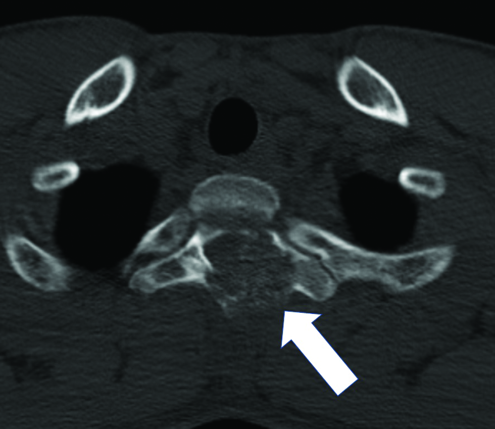 An 18-year-old man suffering from left-sided neck stiffness and shoulder pain underwent computed tomography. Computed tomography scan revealing that the tumor was lytic with a rim of sclerosis and a small area of internal calcification (arrow).