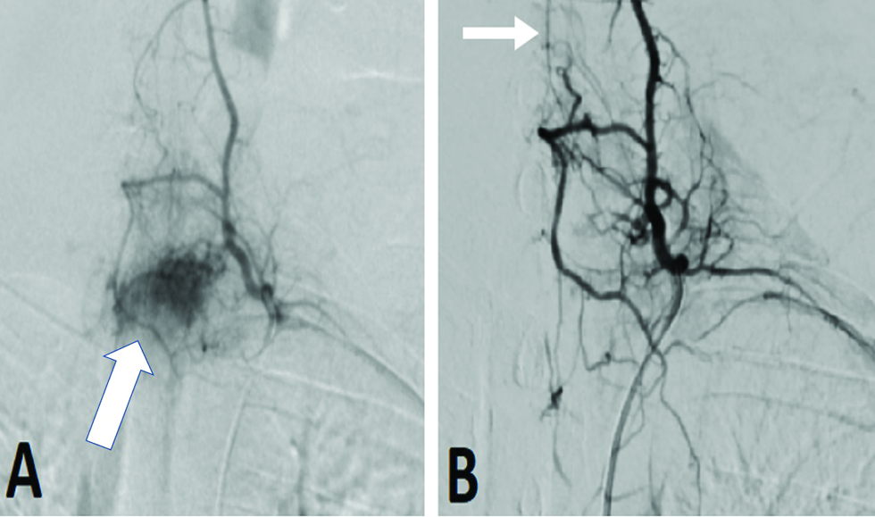 An 18-year-old man suffering from left-sided neck stiffness and shoulder pain underwent digital subtraction angiography. (A) Selective angiogram demonstrated a hypervascular tumor with a feeding artery arising from the left thyrocervical trunk (arrow). (B) Postembolization angiogram showed complete devascularization, with no reflux into the radiculomedullary artery (arrow).
