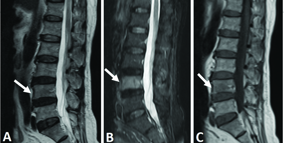 A 68-year-old man with moderate back pain that radiated to the legs underwent spinal magnetic resonance imaging. The L4 vertebral body was isointense on sagittal T2-weighted (A) (arrow) and sagittal T1-weighted (C) (arrow) images but hyperintense on short tau inversion recovery (B) (arrow) images compared with the bone marrow.