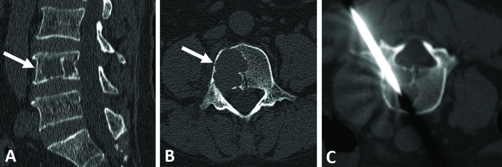 A 68-year-old man with moderate back pain that radiated to the legs underwent computed tomography. (A and B) The lesion was well-defined and osteolytic, without sclerotic borders or internal calcification (arrow). (C) A CT-guided biopsy of the lesion was performed.