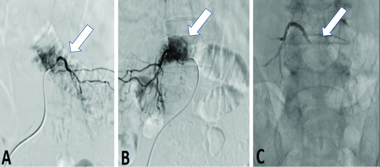 A 68-year-old man with moderate back pain that radiated to the legs underwent digital subtraction angiography. A markedly hypervascular tumor at the L4 vertebral was observed, receiving blood from the bilateral L4 segmental arteries (A and B) (arrow). (C) Post-embolization angiogram demonstrated no residual tumor (arrow).