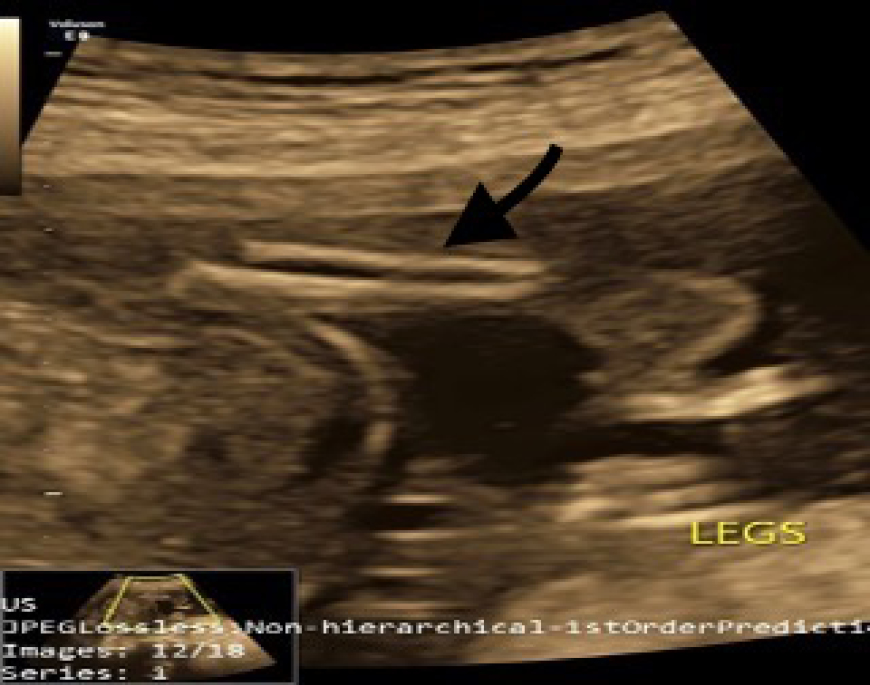 Antenatal ultrasound at 18-20 weeks at the level of the legs shows normal-appearing bilateral tibia and fibula of the right side (arrow).