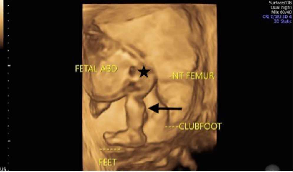 3D ultrasound image at the level of lower limbs clearly demonstrates nonvisualized thigh (asterisk) with a normally developed leg (arrow).