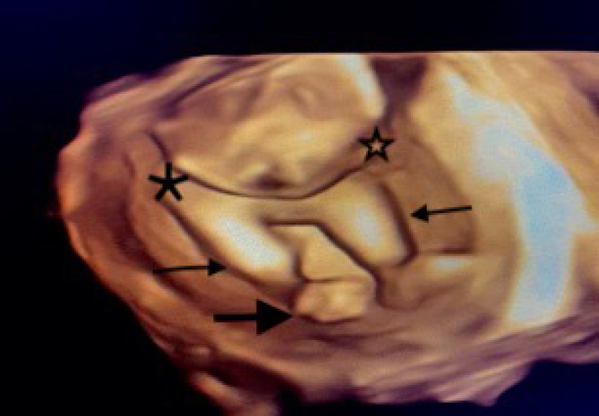 Another 3D ultrasound image at the level of lower limbs demonstrates normally developed both legs (tibia and fibula, denoted by thin arrows) directly articulating with the pelvis (asterisks) with nonvisualization of bilateral thighs (femurs). Note is made of right-sided club foot (bold arrow).