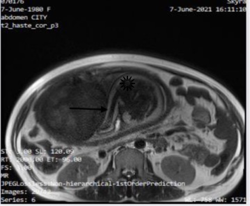 Fetal MRI has done at 32-33 weeks at the level of the fetal pelvis, shows nonvisualization of femur with the tibia and fibula (arrow) in close proximity with the acetabulum (asterisk).