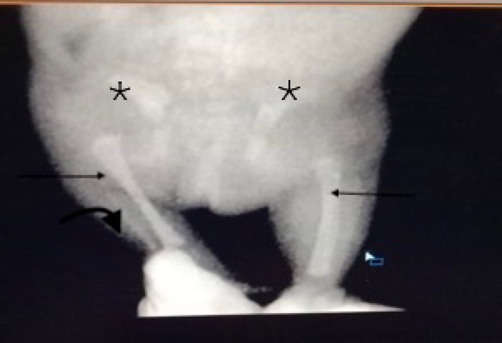 Postnatal X-ray infantogram confirms the prenatal observations. Bilateral femur bones are not seen. Bilateral proximal tibia (arrows) appears femur-like in shape and tibia is seen forming pseudoarthrosis with the acetabulum (asterisks). The acetabulum appears shallow and dysplastic (asterisks). The right fibula is visualized (bold arrow) but the left fibula is not seen clearly (likely non-ossified).