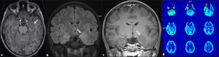 (a) Ill-defined, expansile, T1 isointense, (b) T2 hyperintense, (c) Nonenhancing lesion within the left amygdala and hippocampus with blurring of the gray-white junction in the adjacent anteromedial temporal lobe (arrows). (d) Perfusion imaging demonstrates relative decrease in cerebral blood flow in the left temporal lobe.