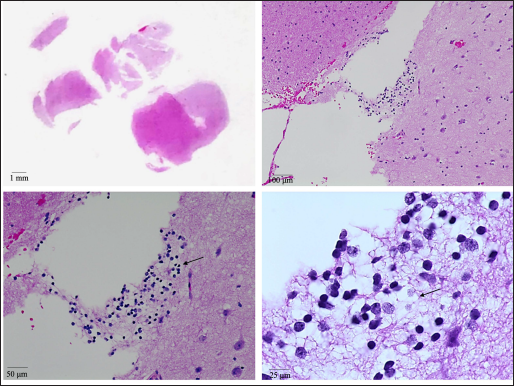 H&E images (at various magnifications) showing a cluster of oligodendrocytes with round nuclei and cytoplasmic clearings (arrows) in the subcortical white matter. Neurons with larger nuclei (relative to oligodendrocytes) can be seen in the adjacent cortex.