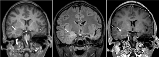 (a) Status-post left anterior temporal lobectomy and left amygdalohippocampectomy with expected postsurgical changes. New ill-defined T1 isointense, (b) T2 FLAIR hyperintense, (c) and nonenhancing lesion in the right amygdala with blurring of the gray-white junction in the right inferomedial temporal lobe (arrows).