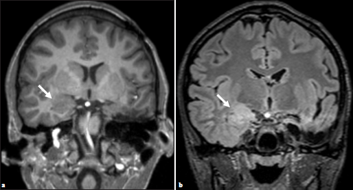 (a) Preoperative imaging demonstrating subtle, ill-defined T2 hyperintense lesion within the right amygdala, (b) which appears increased in constituency on postsurgical T2 FLAIR (arrows).