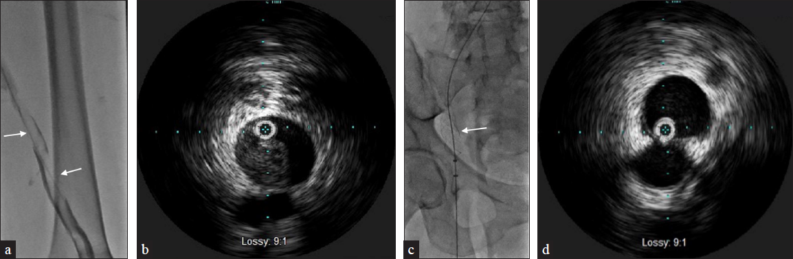 A 69-year-old female with stage 4 uterine carcinosarcoma presents with left lower extremity swelling. US (not shown) demonstrates thrombus from the left common femoral to popliteal veins. (a) Venography demonstrates multiple filling defects (arrows) beginning within the common iliac vein and extending to the superficial femoral and popliteal veins. (b) IVUS identifies nonechogenic thrombus throughout including the common iliac vein. (c) Patient underwent Inari ClotTriever thrombectomy (arrow) of the lower extremity. (d) Repeat IVUS shows almost complete resolution of acute thrombus.