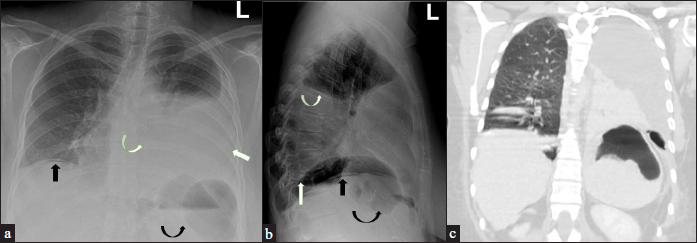 (a) A 44-year-old female patient status post sleeve gastrectomy day nine presented with chest pain vomiting, and tachycardia. Frontal chest radiograph showing free air under the right diaphragm (black arrow), left subphrenic localized air pockets (curved black arrow), left pleural effusion (white arrow), and left basal lung consolidation (curved white arrow). (b) Lateral chest radiograph showing free air under the diaphragm (black arrow), localized air pocket under the diaphragm (curved black arrow), elevated hemidiaphragm (white arrow), and pleural effusion (curved white arrow). (c) Coronal CT chest showing left pleural effusion, left basal lung collapse/consolidation, left subphrenic large air pocket, and elevated left diaphragm.