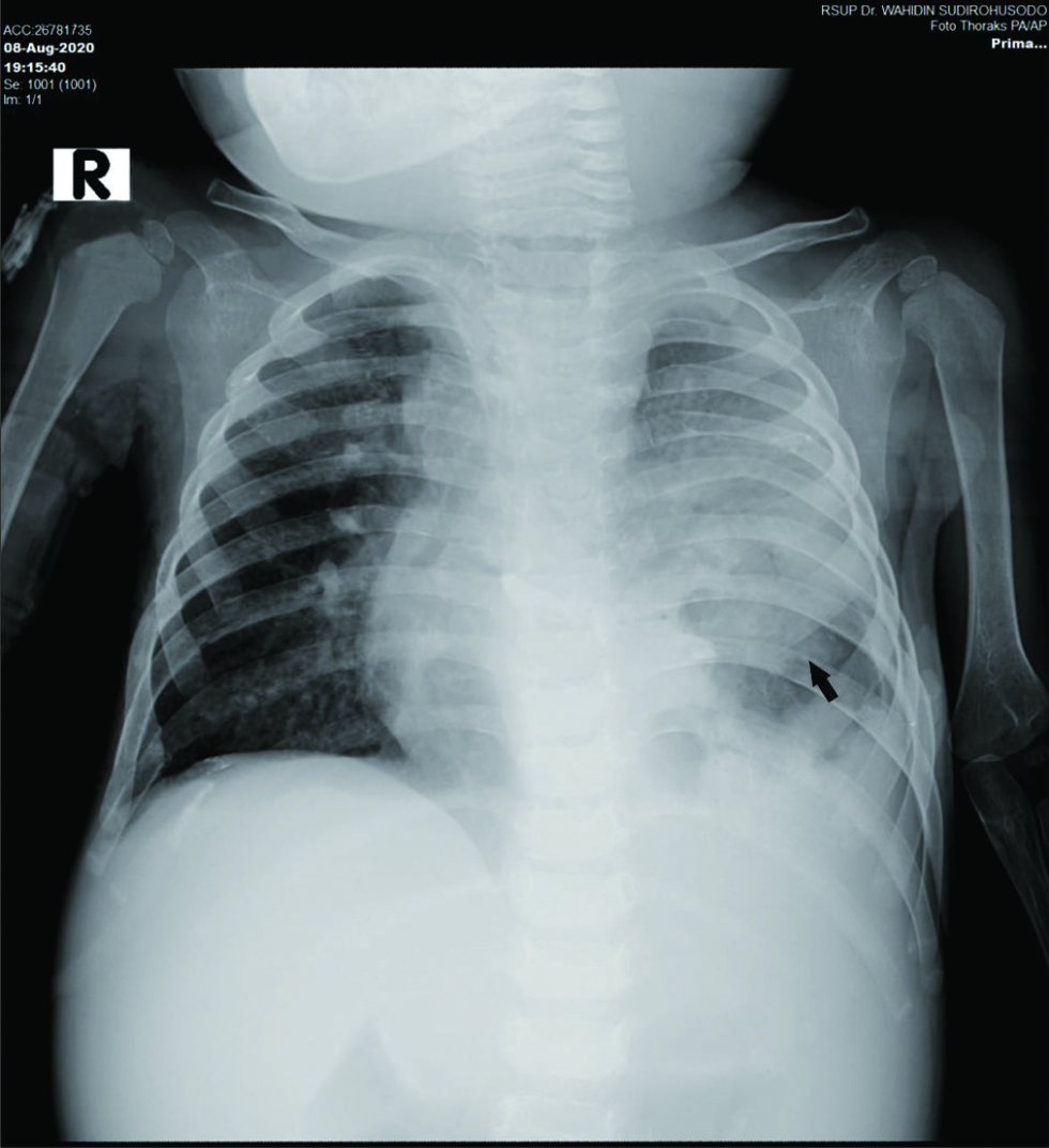 A 1-year-7-months-old infant with multiple organ tuberculomas who presented with shortness of breath, lumps in the neck and weakness on in both legs and right hand. Anteroposterior projection of chest radiograph showed soft tissue density with unclear margin at left lung field (black arrow). There was also obscuration of the left costo-phrenicus angle.