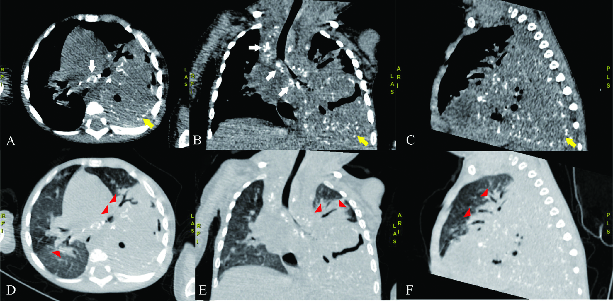 A 1-year-7-months-old infant with multiple organ tuberculomas who presented with shortness of breath, lumps in the neck and weakness on in both legs and right hand. (A-C) Mediastinal window in axial, coronal, and sagittal view of nonenhanced chest CT showed homogeneous mass with punctate calcification and air density inside, relatively well-defined, regular margins measuring ± 10.1 x 6.48 x 8.28 cm on inferior lobe of the left lung (black arrow) pushing the left superior lobe and left inferior lower bronchus of the lung left to the anterior and mediastinal organ to the contralateral. (D-F) There were also multiple lymphadenopathies at right paratrachea, subcarina dan right peribronchial (white arrows). Lung window in axial, coronal, and sagittal view of nonenhanced chest CT showed consolidation with air bronchogram sign inside the superior lobe and the medioposterobasal segment of the inferior lobe of the right lung (arrow heads).