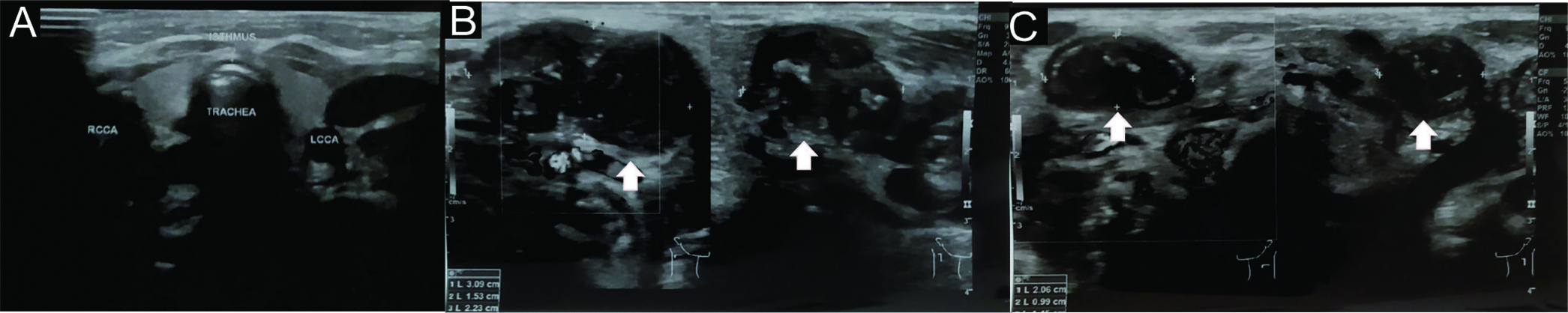 A 1-year-7-months-old infant with multiple organ tuberculomas who presented with shortness of breath, lumps in the neck and weakness on in both legs and right hand. Cervical ultrasound showed (A) normal bilateral thyroid lobes and (B-C) multiple well demarcated, irregular edges, clustered hypoechoic lesions with coarse and peripheral calcification at both cervical region (white arrows) (level II, III, IV, and V).