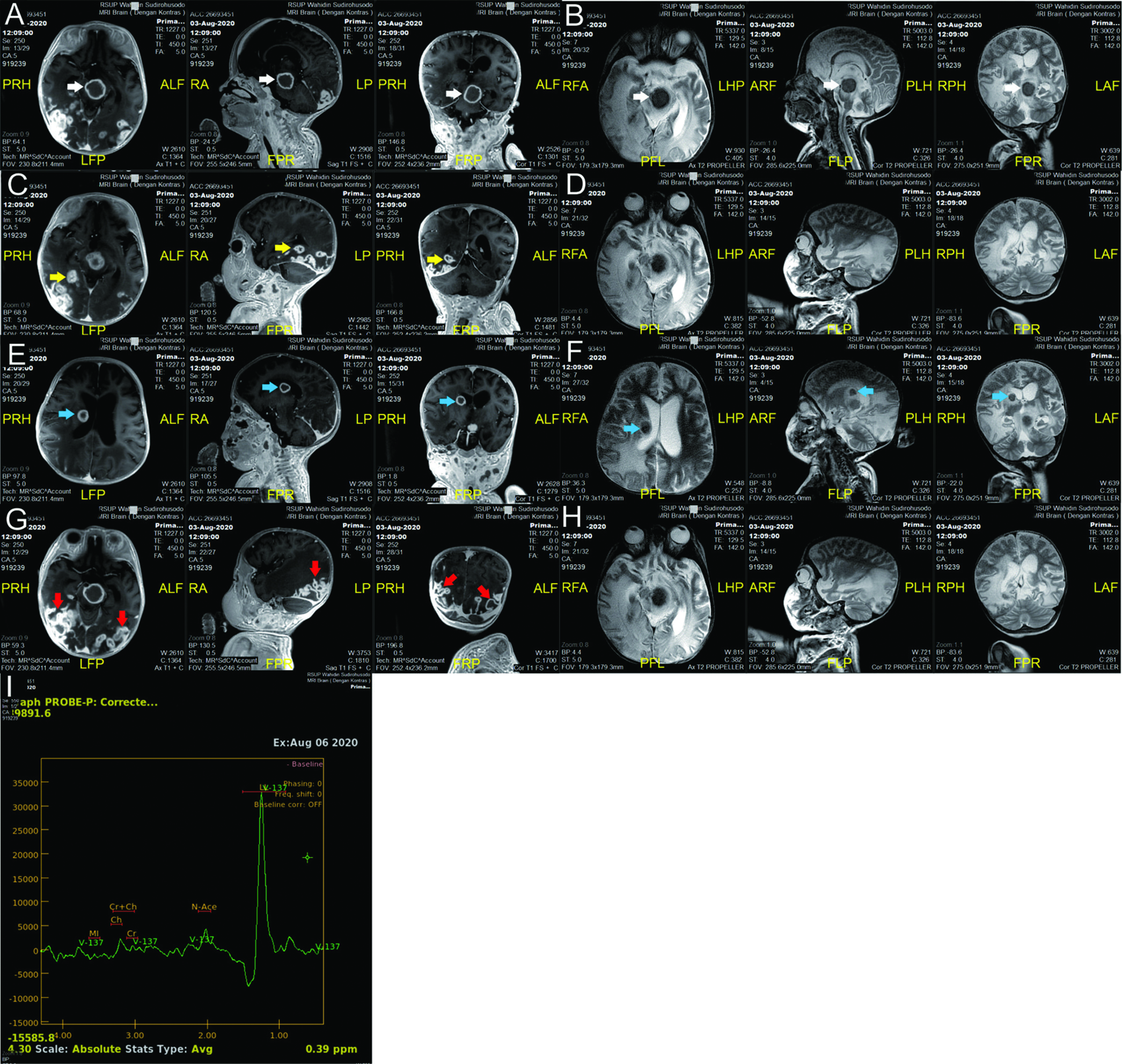 A 1-year-7-months-old infant with multiple organ tuberculomas who presented with shortness of breath, lumps in the neck and weakness on in both legs and right hand. (A-H) Axial, coronal and sagittal view of brain MRI with contrast showed multiple isointense lesions on T1 with peripheral rim enhancement post contrast, hypointense with slightly hyperintense edges on T2 well-defined, regular surface with perifocal edema in the midbrain (white arrow), right occipital lobe (yellow arrow), and right caudate nucleus (blue arrow) with the largest size ± 2.51 x 2.65 x 2.57 cm. There was also focal enhancement of the sulci and gyri of bilateral occipital region with extensive white matter edema of the bilateral parietotemporooccipital lobes (red arrow), especially the right side. (I) MR Spectrometry showed high lipid-lactate peak.