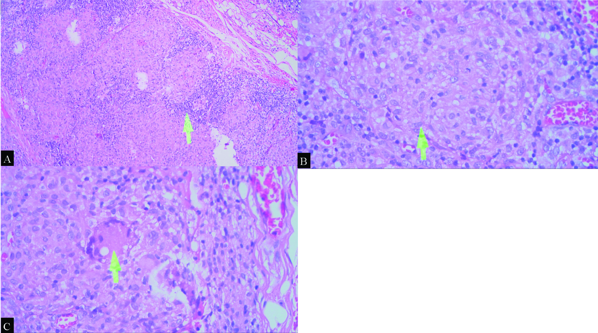 A 1-year-7-months-old infant with multiple organ tuberculomas who presented with shortness of breath, lumps in the neck and weakness on in both legs and right hand. Histopathological review of the lumps at cervical region, using hematoxylin and eosin (H&E stain) demonstrated (A) granuloma with lymphocytes at the edges (arrow), 20x magnification; (B, C) There were also epithelioid histiocytes (arrow) and Datia Langhans cells (arrow) between the granulomas, respectively. No central caseous necrotic mass formation was seen in this preparation, ×40 magnification.