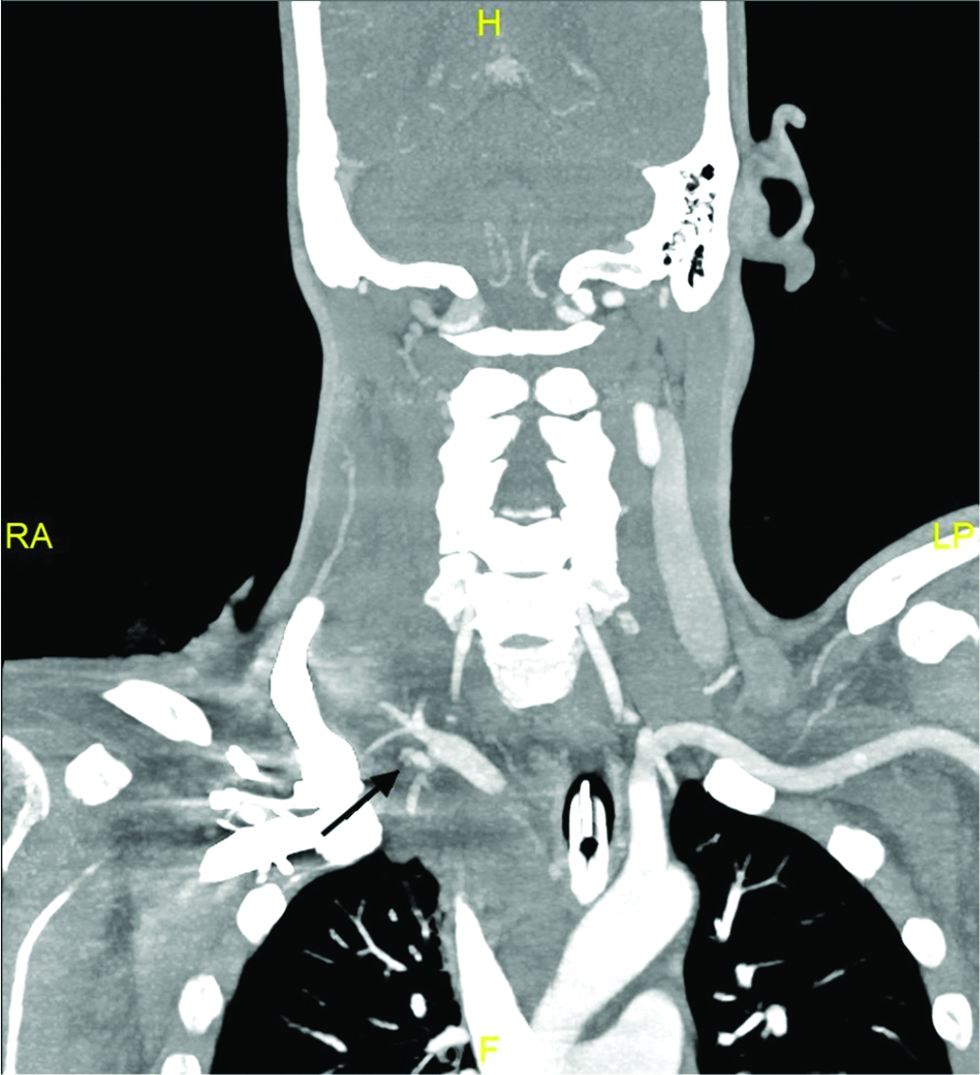 40-year-old man with suspected arterial injury after central venous catheter insertion. (b) CT angiogram(coronal) of the neck showed contrast extravasation(arrow) at the junction between the right subclavian artery and internal mammary artery.