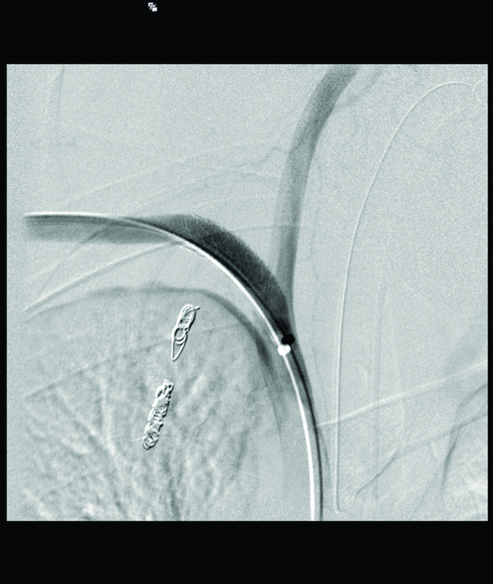 40-year-old man with right subclavian artery injury after central venous catheter insertion. A peripheral stent graft is deplored in right subclavian artery after right internal mammary artery embolization. (d) Post balloon angioplasty DSA of right subclavian artery showed no further contrast extravasation.