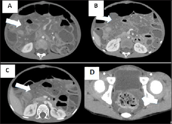 A 5-year-old male patient with NF-1 presented with abdominal pain and distention. Portal venous phase CT images: (A, B, C) Diffuse lesions of small bowel mesentery (white arrow), slightly enhancing and encasing the mesenteric vessels without invasion or causing vessel stenosis/obstruction. (D) Similar lesions surrounding the rectum (white arrow).