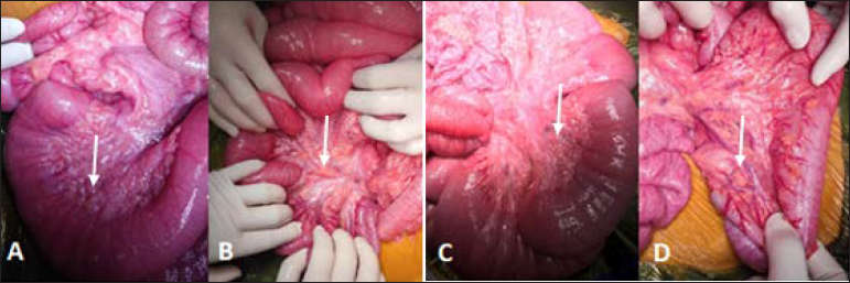 A 5-year-old male patient with NF-1 presented with abdominal pain and distention. Intraoperative findings: (A) Dilated small bowel (white arrow); (B, C, D) The entire small bowel mesentery and the right half of transverse mesocolon had many yellow rigid nodules (white arrow), along the vessels.