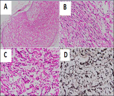 A 5-year-old male patient with NF-1 presented with abdominal pain and distention. Pathologic images of the mesenteric lesions: H&E stain x40 (A), x200 (B, C) showed tumor tissue structure consisting of clusters of long slender spindle cells with wavy cytoplasm, slightly mucoid basal substances, blood vessels proliferation without malignant cells. (D) The immunohistochemical stain showed S100 (+).