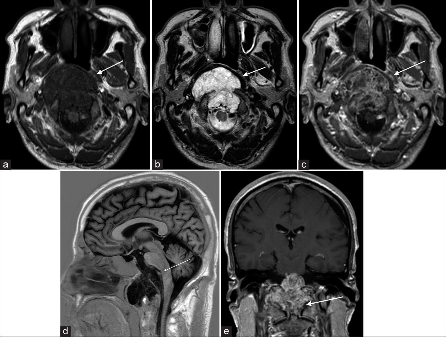 (a-c) Contrast MRI brain. A lobulated T1-weighted hypointense and T2-weighted hyperintense clival mass with moderate heterogeneous contrast enhancement, showing a honeycombing appearance (white arrows). (d) Contrast MRI brain. Extension of the mass into the foramen magnum with compression onto the brainstem. (e) Contrast MRI brain. Inferior extension with dens erosion (white arrows).