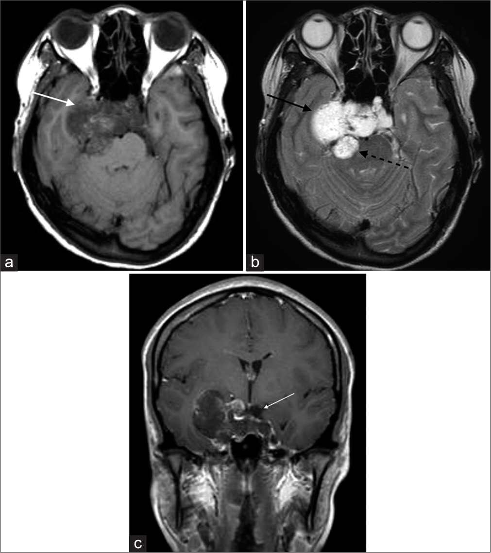 (a and b) Contrast MRI brain. Lateral extension of the mass into the right middle cranial fossa (white arrow), right cavernous sinus, and right petrous apex with compression onto the right mesial temporal lobe (black arrow). Posterior extension onto the midbrain was also evident (dotted black arrow). (c) Contrast MRI brain. Superior extension of the mass with compression on pituitary stalk and optic chiasm.