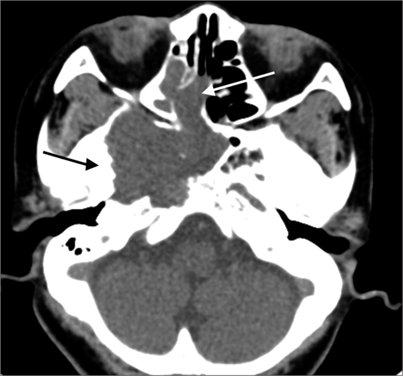 Plain CT brain. An lobulated mass centered at the right petroclival region (dark arrow) with extension into the right posterior ethmoid sinus and right sphenoid sinus (white arrow).
