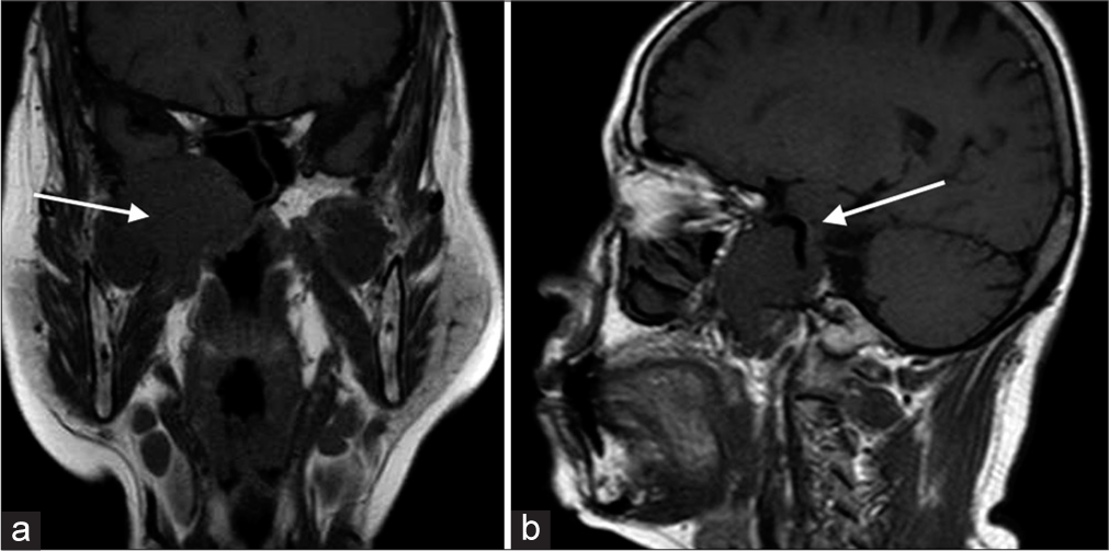 (a) Contrast MRI scan. Inferior extension into the right infratemporal fossa, abutting the pterygoid muscles (white arrow). (b) Contrast MRI scan. Encasement of the petrous and cavernous portion of the right internal carotid artery (white arrow).