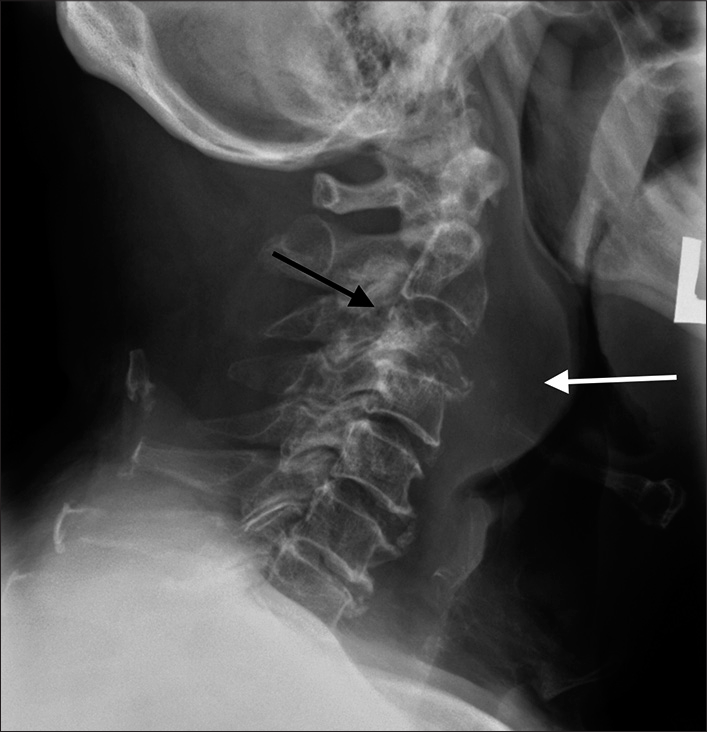 Lateral projection of cervical spine radiograph. Lytic cervical spine lesion at C3 level with partial vertebral collapse (black arrow). It was associated with prevertebral soft-tissue swelling spanning from C2 to C4 levels (white arrow).