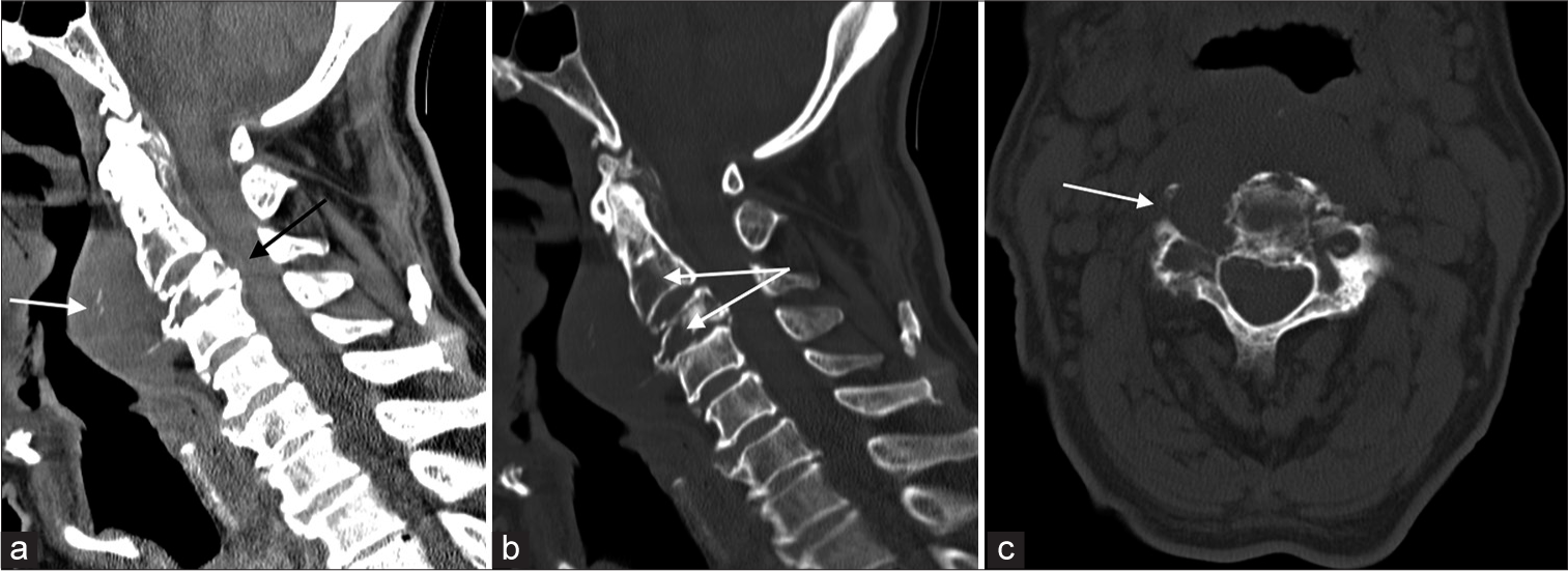 (a) Plain CT cervical spine. Cervical spine tumor at C2–C3 levels. It was associated with prevertebral soft-tissue mass spanning across C2–C4 levels with intratumoral calcifications within (white arrow). There was epidural involvement at the anterior epidural space (black arrow). (b) Plain CT cervical spine. Bone destruction at C2 and C3 vertebrae. (c) Plain CT cervical spine. Involvement of the right C3 neuroforamen.