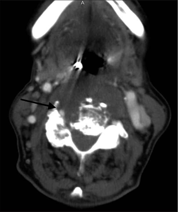 Contrast CT cervical spine. Encasement of the right vertebral artery which remained opacified (black arrow).