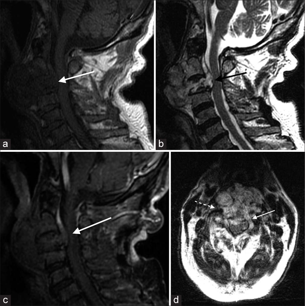 (a-c) MRI cervical spine. A T1-weighted hypointense and T2-weighted hyperintense cervical spine tumor with mild contrast enhancement. (d) The mass extended into and obliterated the anterior epidural space, demonstrating a draped curtain sign (white arrow). Normal T2-weighted flow void pattern of the right vertebral artery was preserved (dotted arrow).