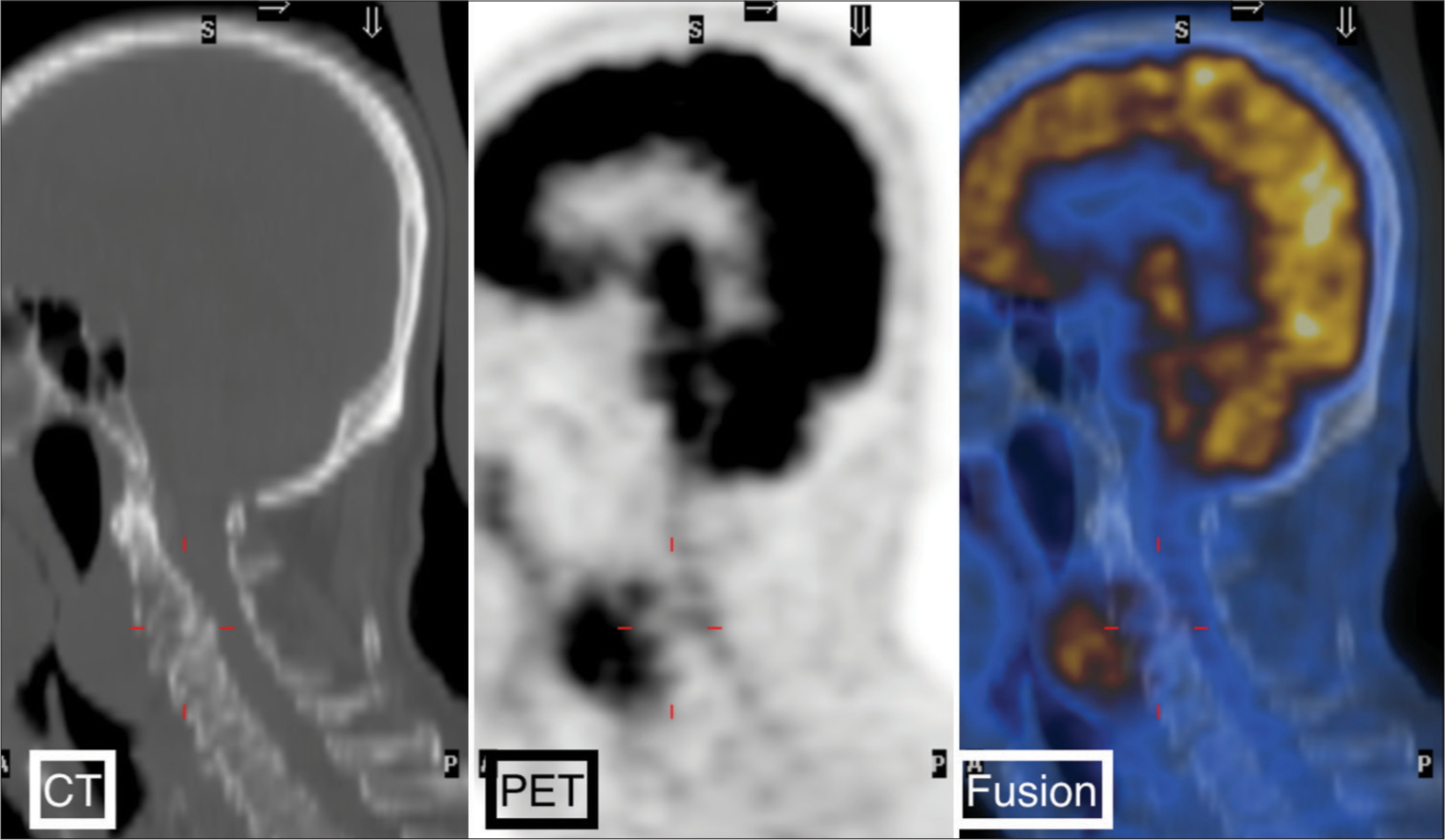 PET-CT scan. An increase in SUV (SUVmax 6.9) was demonstrated.
