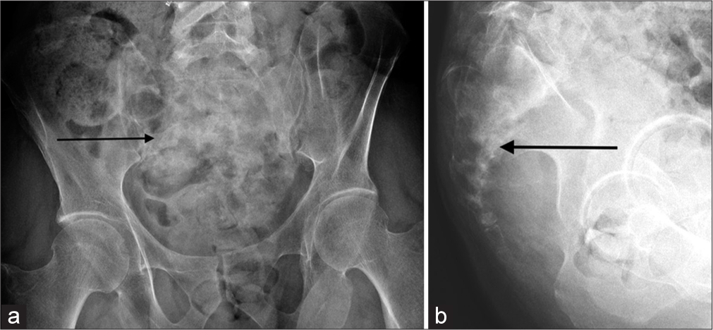 (a and b) Frontal and lateral radiographs of the sacrum. Destructive lytic lesion sacral lesion, with better demonstration on the lateral view (black arrows).