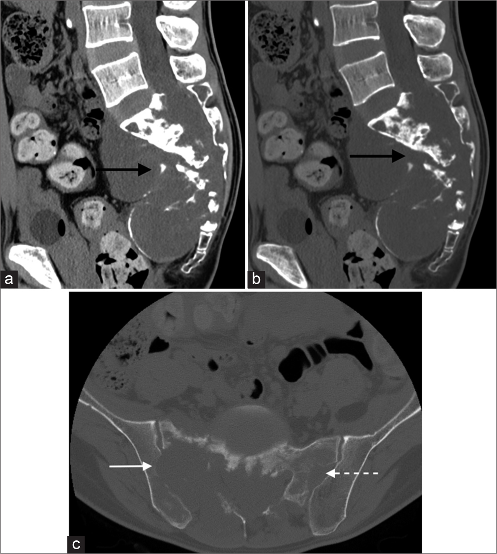 (a and b) Plain CT pelvis. Destructive sacral lytic lesion with soft-tissue mass containing intratumoral calcifications. (c) Plain CT pelvis. The mass eroded the right sacral foramen, extended across the right sacroiliac joint, and invaded the right iliac bone (white arrow). It also extended to the left sacroiliac joint (white dotted arrow).