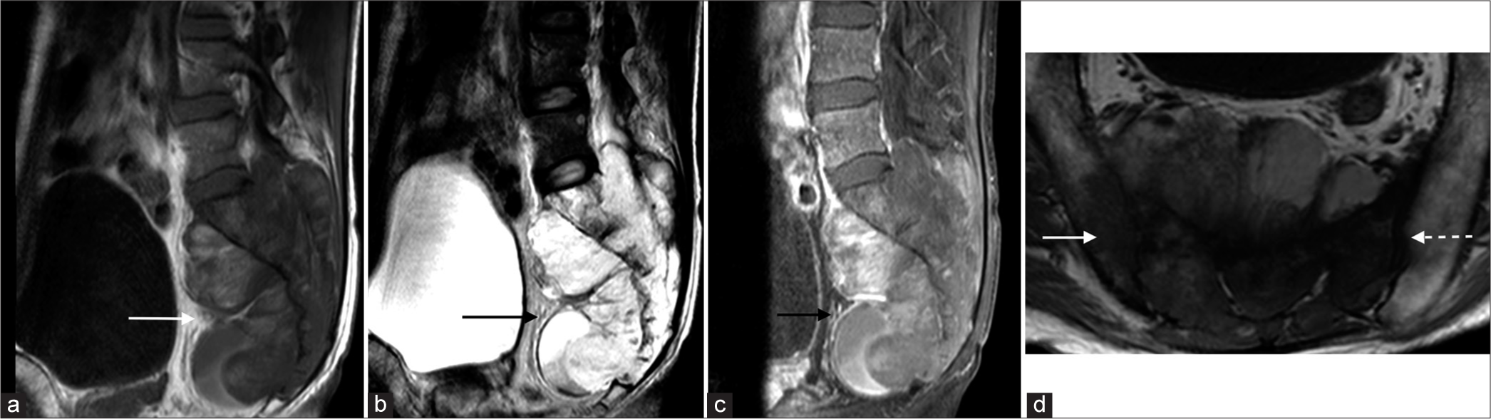 (a-c) Contrast MRI pelvis. A lobulated sacral mass with T1-weighted isointense and T2-weighted hyperintense signal showing mild contrast enhancement. (d) Contrast MRI pelvis. It invaded the right sacroiliac joint and the right ilium (white arrow). There was also involvement of the left sacroiliac joint (white dotted arrow).