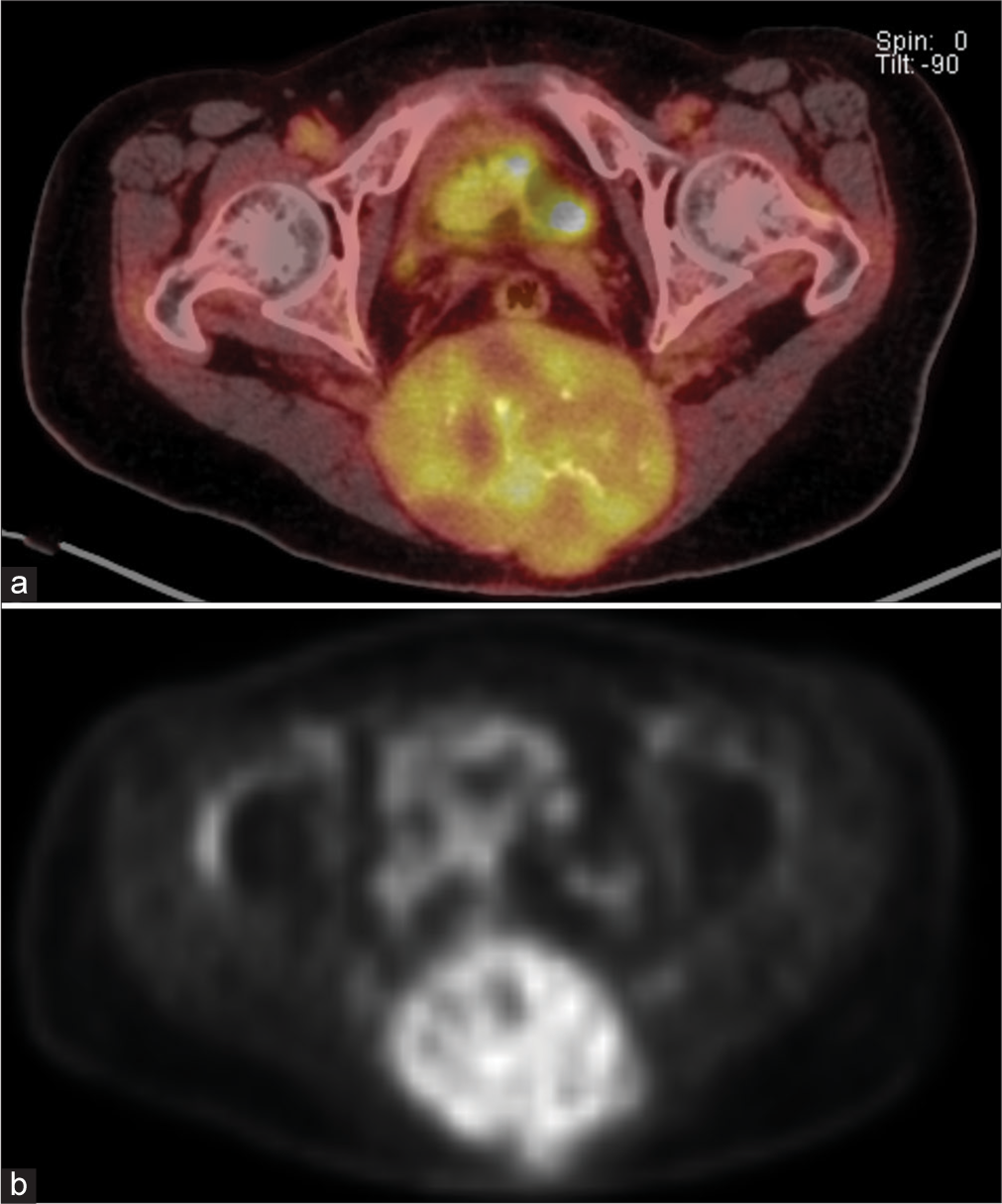 a and b PET-CT scan. An increase in uptake of the sacral tumour (SUVmax 6.7).